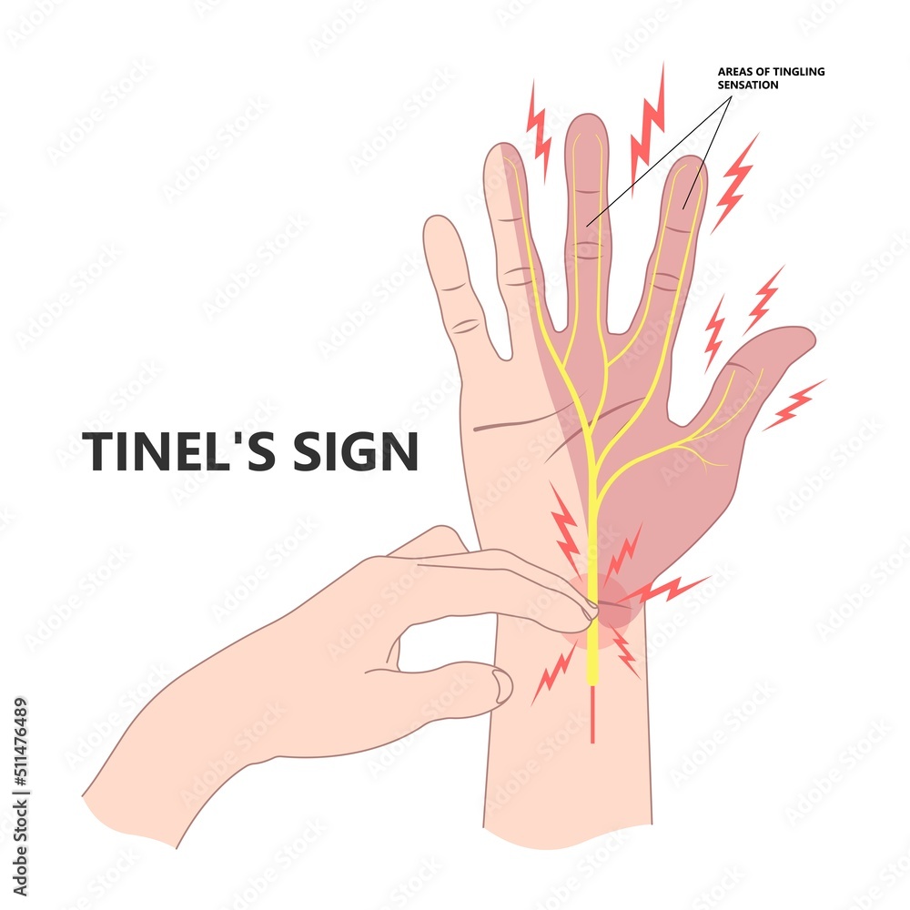 Tinel’s and phalen's sign test for carpal tunnel syndrome compressed ... Why Is It Important To Review Your Insurance Annually